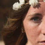 Effective Strategies for Reducing Freckles